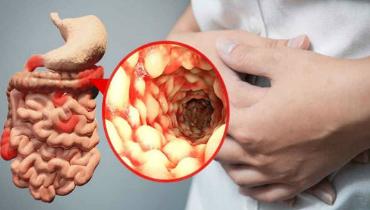 Boala Crohn și principalele simptome